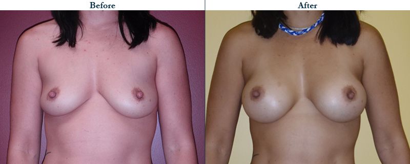 Tulsa Cosmetic Surgery Whitlock Breast Augmentation Before After Web7