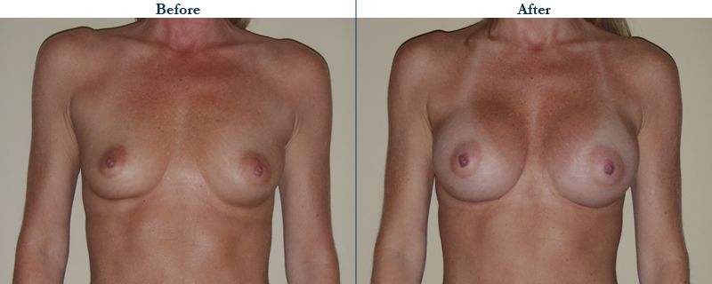 Tulsa Cosmetic Surgery Whitlock Breast Augmentation Before After Web8