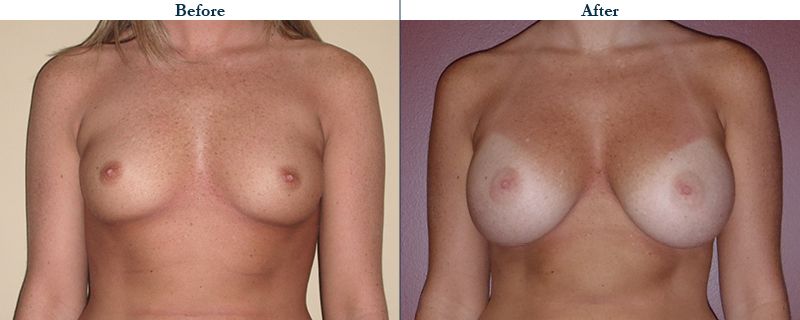 Tulsa Cosmetic Surgery Whitlock Breast Augmentation Before After Web9