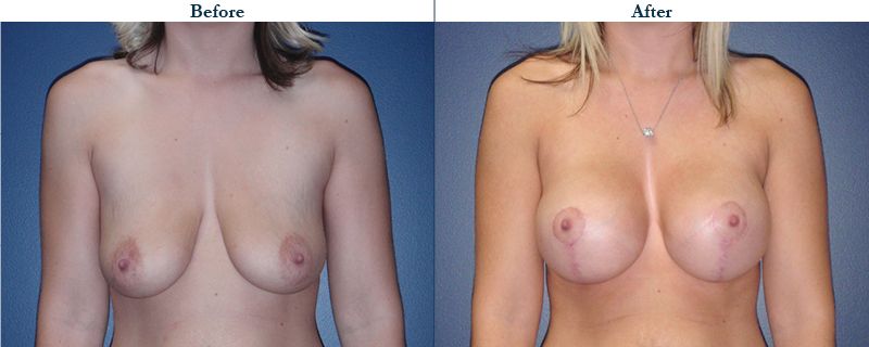 Tulsa Cosmetic Surgery Whitlock Breast Lift Before After Web23