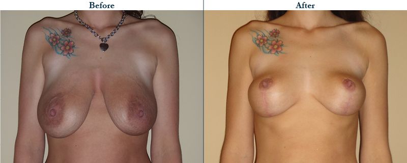 Tulsa Cosmetic Surgery Whitlock Breast Lift Before After Web24