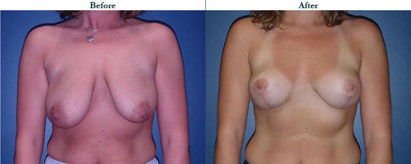 Tulsa Cosmetic Surgery Whitlock Breast Lift Before After Web25