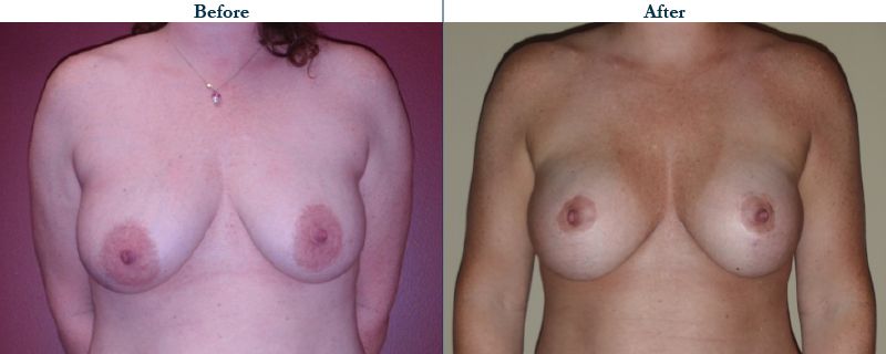 Tulsa Cosmetic Surgery Whitlock Breast Lift Before After Web29