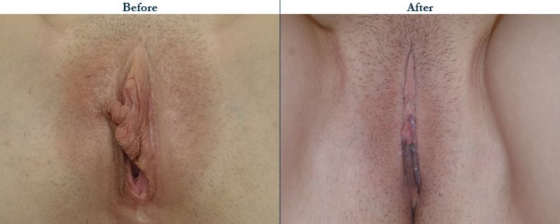 Tulsa Cosmetic Surgery Whitlock Labiaplasty Before After Web43