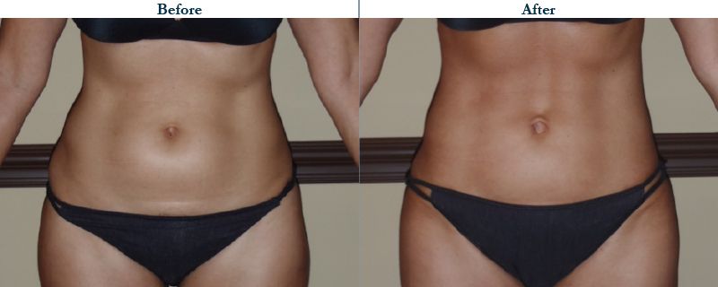 Tulsa Cosmetic Surgery Whitlock Liposuction Before After Web34