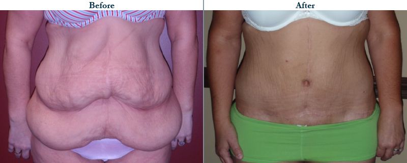 Tulsa Cosmetic Surgery Whitlock Tummy Tuck Before After Web37